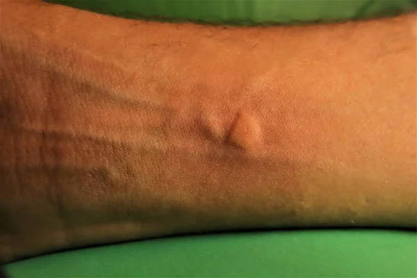 Deri alerjisi, alerji. Sarı eşekarısı: bir eşek arısı işçisi tarafından sokulmuş. Sarı eşek arısı bir adamın kolunu sokar. Ayrıca Alman eşekarısı ya da Avrupa eşekarısı olarak da bilinir. Sarı ceketli ya da sarı ceketli. Eşek arıları, böcekler, böcekler