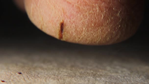 Grietas Talón Cerca Las Grietas Piel Hombre Curación Heridas Patología — Vídeos de Stock