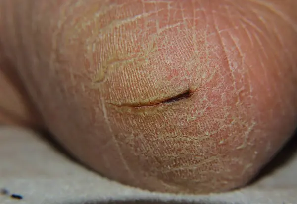 Heel cracks. Close up of a skin cracks in man. Wound Healing, Pathology. Healthcare, Medicine. Health care