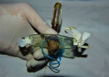 Tracheostomy: This tube almost caused patient to choke due to the large secretions suddenly occurred despite cleaning this catheter daily. This procedure is dangerous despite the continuous monitoring clipart