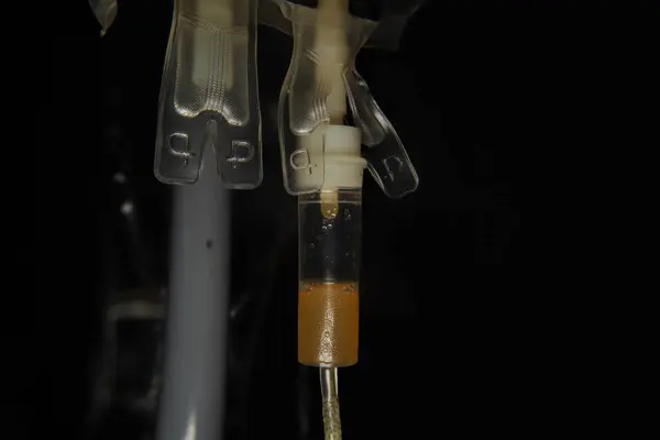 stock image Bag of plasma hanging from a pole. Blood (plasma) is transferred to a patient in a hospital. Close up blood bag in laboratory medical concept. Blood transfer