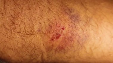 Motosikletten düşme sonucu bacağında morluk ve sıyrık var. Travma ve iyileşme aşamalarını gösteren ayrıntılı deri yaralanmaları. Tıbbi, güvenlik ve kaza farkındalığı içeriği için kullanışlı.