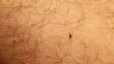 Yakın plan çekimde bir adamın bacağında sürünen bir pire. Gerçek dünyada parazite maruz kalma, böcek davranışları ve sağlık tehlikelerinin altını çiziyor. Eğitim, tıbbi ve çevresel bağlamlar için kullanışlı.