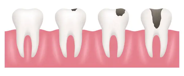 Υγιή Δόντια Και Δόντια Τερηδόνα Κλιμάκιο Διανύσματος — Διανυσματικό Αρχείο