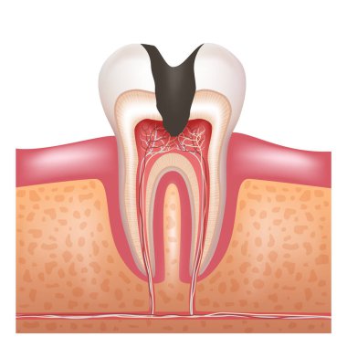 Derin dişleri olan bir diş. Pulpitis. Vektör illüstrasyonu.
