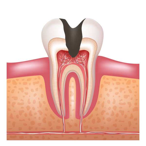 A tooth with deep caries. Pulpitis. Vector illustration.