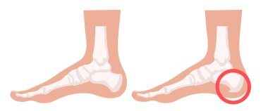 Heel spur illustration. Design elements on the theme of plantar fasciitis. Vector set. clipart