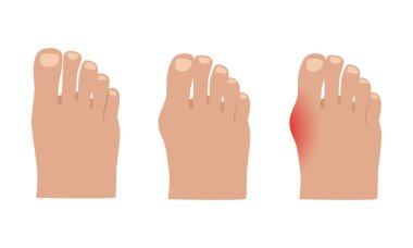 Hallux valgus. Baş parmak ekleminde Valgus deformasyonu. Vektör illüstrasyonu.