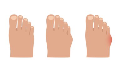 Taylor deformasyonu. Küçük ayak parmağı ekleminde Valgus deformasyonu. Vektör illüstrasyonu.