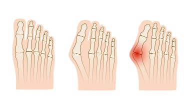 Hallux valgus. Baş parmak ekleminde Valgus deformasyonu. Vektör illüstrasyonu.