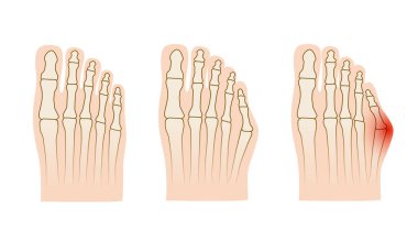 Taylor deformasyonu. Küçük ayak parmağı ekleminde Valgus deformasyonu. Vektör illüstrasyonu.