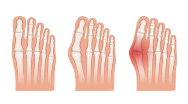 Hallux valgus. Baş parmak ekleminde Valgus deformasyonu. Vektör illüstrasyonu.