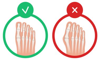 Hallux valgus. Valgus deformity of the big toe joint. Vector illustration. clipart