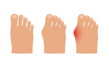 Hallux valgus. Baş parmak ekleminde Valgus deformasyonu. Vektör illüstrasyonu.