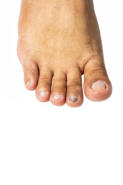 Ayak tırnağında sert bir cisimle vurulma sonucu oluşan hematom oluşumu..