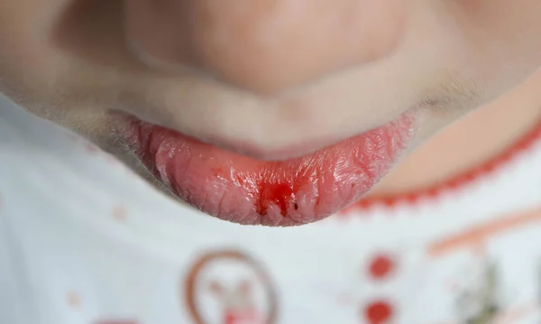 Dry Damaged Lips Girl Close Lip Fissure Bleeding Sick Cracked — Stock Photo, Image