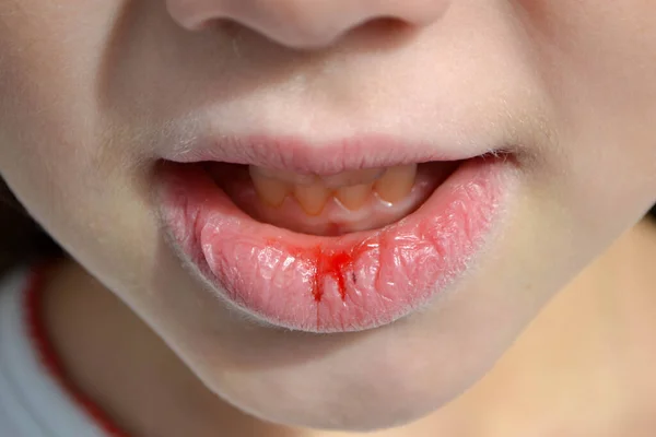 Trockene Und Beschädigte Lippen Eines Mädchens Nahaufnahme Lippenrisse Und Blutungen — Stockfoto