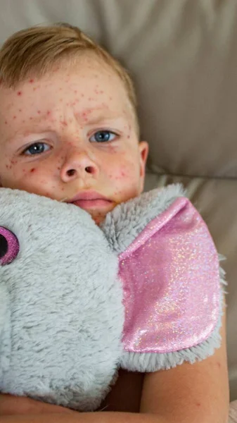 Природная Вакцинация Заразное Заболевание Больной Ребенок Ветрянкой Вирус Варицеллы Пузырчатая — стоковое фото