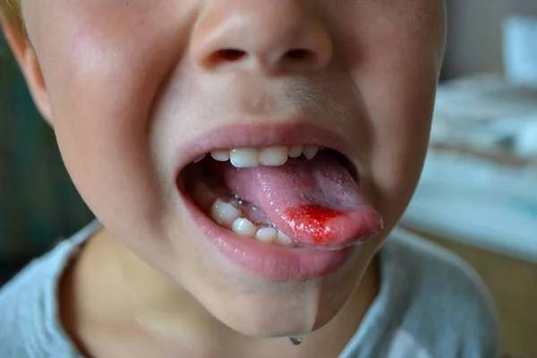 Großaufnahme Von Lippen Zunge Ausstülpung Von Blut Kinderzunge Gebissen Hochwertiges — Stockfoto
