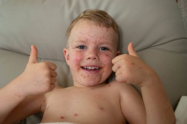 Doğal aşılama. Bulaşıcı bir hastalık. Suçiçeği hastası bir çocuk. Varicella virüsü ya da çocuk vücudunda ve yüzünde su çiçeği kabarcığı kızarıklığı. Yüksek kalite fotoğraf