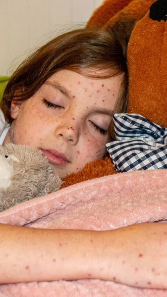 Natural Vaccination Contagious Disease Sick Child Chickenpox Varicella Virus Chickenpox — Stock Photo, Image