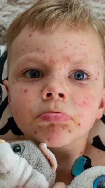 Vaccinazione Naturale Malattie Contagiose Bambino Malato Con Varicella Virus Della — Foto Stock