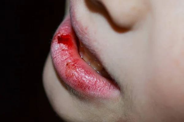 건조하고 상처입은 입술이야 클로즈업 출혈이야 상처입은 조직이요 갈라진 있는건 입술로 — 스톡 사진