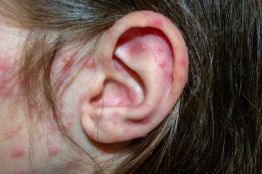 Doğal aşılama. Bulaşıcı bir hastalık. Suçiçeği hastası bir çocuk. Varicella virüsü ya da çocuk vücudunda ve yüzünde su çiçeği kabarcığı kızarıklığı. Yüksek kalite fotoğraf. 