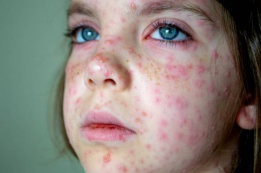 Doğal aşılama. Bulaşıcı bir hastalık. Suçiçeği hastası bir çocuk. Varicella virüsü ya da çocuk vücudunda ve yüzünde su çiçeği kabarcığı kızarıklığı. Yüksek kalite fotoğraf. 