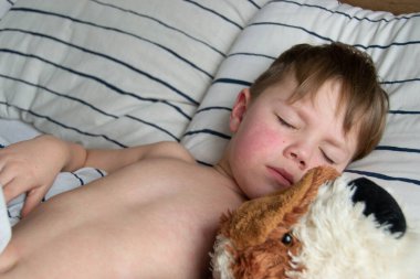 Virüs hastalığı. Çocuğun vücudunda kızarıklık yapıyor. Alerji. Kızamığı olan yakışıklı bir çocuk yumuşak oyuncağıyla yatakta uyuyor.