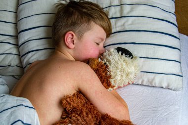 Virüs hastalığı. Çocuğun vücudunda kızarıklık yapıyor. Alerji. Kızamığı olan yakışıklı bir çocuk yumuşak oyuncağıyla yatakta uyuyor.