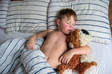 Virüs hastalığı. Çocuğun vücudunda kızarıklık yapıyor. Alerji. Kızamığı olan yakışıklı bir çocuk yumuşak oyuncağıyla yatakta uyuyor.