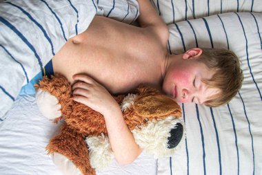 Virüs hastalığı. Çocuğun vücudunda kızarıklık yapıyor. Alerji. Kızamığı olan yakışıklı bir çocuk yumuşak oyuncağıyla yatakta uyuyor.