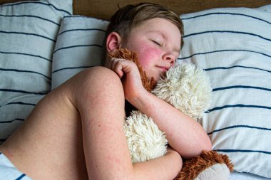 Virüs hastalığı. Çocuğun vücudunda kızarıklık yapıyor. Alerji. Kızamığı olan yakışıklı bir çocuk yumuşak oyuncağıyla yatakta uyuyor.