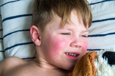 Virüs hastalığı. Çocuğun vücudunda kızarıklık yapıyor. Alerji. Kızamığı olan yakışıklı bir çocuk yumuşak oyuncağıyla yatakta uyuyor.