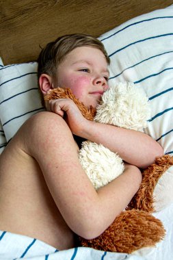 Virüs hastalığı. Çocuğun vücudunda kızarıklık yapıyor. Alerji. Kızamığı olan yakışıklı bir çocuk yumuşak oyuncağıyla yatakta uyuyor.