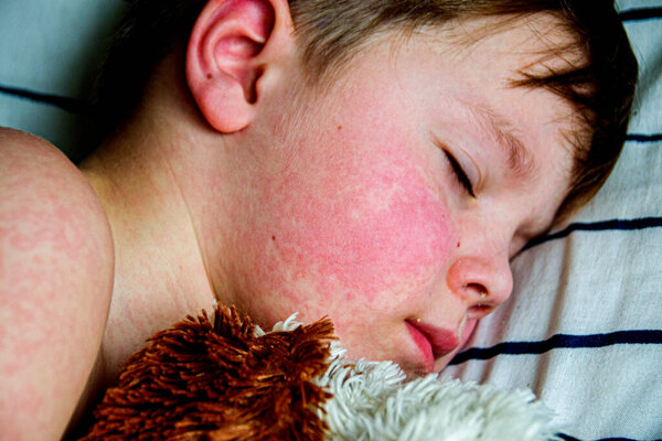 Viral disease. Measles rash on the body of the child. Allergy. A handsome boy with measles is sleeping in bed with his soft toy High quality photo