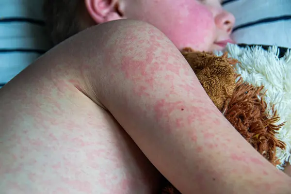 Вірусні Захворювання Кору Висип Тілі Дитини Алергія Красивий Хлопчик Кіркою — стокове фото