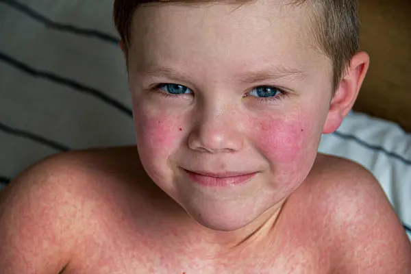 病毒性疾病 麻疹皮疹在孩子身上 一个患麻疹的英俊男孩正带着他的软玩具睡在床上 — 图库照片#