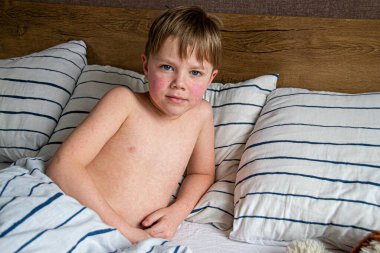 Virüs hastalığı. Çocuğun vücudunda kızarıklık yapıyor. Alerji. Kızamığı olan yakışıklı bir çocuk yumuşak oyuncağıyla yatakta uyuyor.