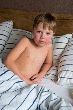 Virüs hastalığı. Çocuğun vücudunda kızarıklık yapıyor. Alerji. Kızamığı olan yakışıklı bir çocuk yumuşak oyuncağıyla yatakta uyuyor.