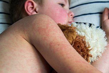 Virüs hastalığı. Çocuğun vücudunda kızarıklık yapıyor. Alerji. Kızamığı olan yakışıklı bir çocuk yumuşak oyuncağıyla yatakta uyuyor.