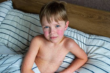 Virüs hastalığı. Çocuğun vücudunda kızarıklık yapıyor. Alerji. Kızamığı olan yakışıklı bir çocuk yumuşak oyuncağıyla yatakta uyuyor.