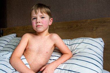 Virüs hastalığı. Çocuğun vücudunda kızarıklık yapıyor. Alerji. Kızamığı olan yakışıklı bir çocuk yumuşak oyuncağıyla yatakta uyuyor.