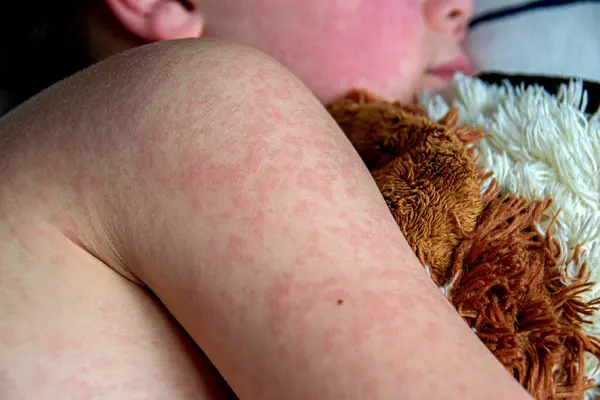 病毒性疾病 麻疹皮疹在孩子身上 一个患麻疹的英俊男孩正带着他的软玩具睡在床上 — 图库照片#