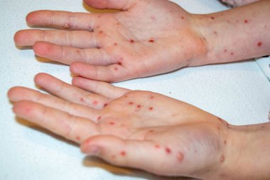 Doğal aşılama. Bulaşıcı bir hastalık. Suçiçeği hastası bir çocuk. Varicella virüsü ya da çocuk vücudunda ve yüzünde su çiçeği kabarcığı kızarıklığı. Yüksek kalite fotoğraf. 