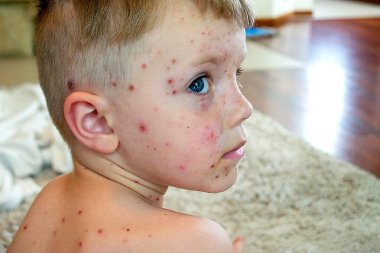 Doğal aşılama. Bulaşıcı bir hastalık. Suçiçeği hastası bir çocuk. Varicella virüsü ya da çocuk vücudunda ve yüzünde su çiçeği kabarcığı kızarıklığı. Yüksek kalite fotoğraf