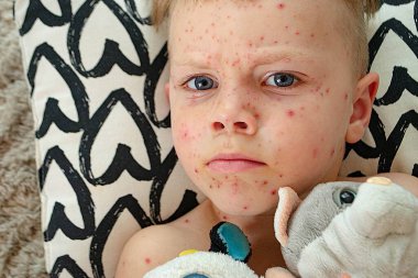 Doğal aşılama. Bulaşıcı bir hastalık. Suçiçeği hastası bir çocuk. Varicella virüsü ya da çocuk vücudunda ve yüzünde su çiçeği kabarcığı kızarıklığı. Yüksek kalite fotoğraf