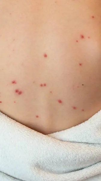 stock image Natural vaccination. Contagious disease. Sick child with chickenpox. Varicella virus or Chickenpox bubble rash on child body and face. High quality photo