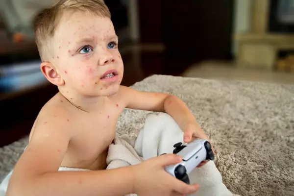 stock image Natural vaccination. Contagious disease. Sick child with chickenpox. Varicella virus or Chickenpox bubble rash on child body and face. High quality photo